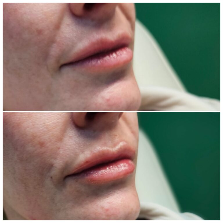 Before and after 1ml Aessoa lip filler treatment at our Maidstone aesthetics clinic.