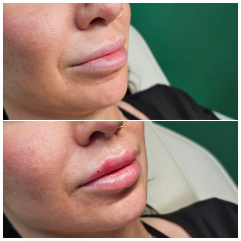 Natural-looking 1ml Aessoa lip filler result by Awlin Beauty in Maidstone.