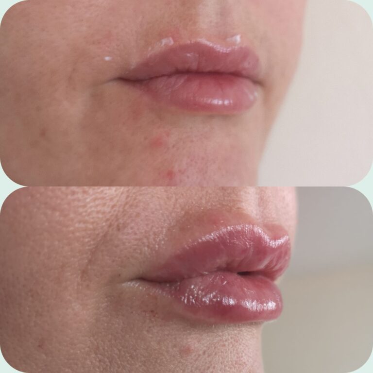 Before and after Aessoa lip filler result at Awlin Beauty Maidstone.