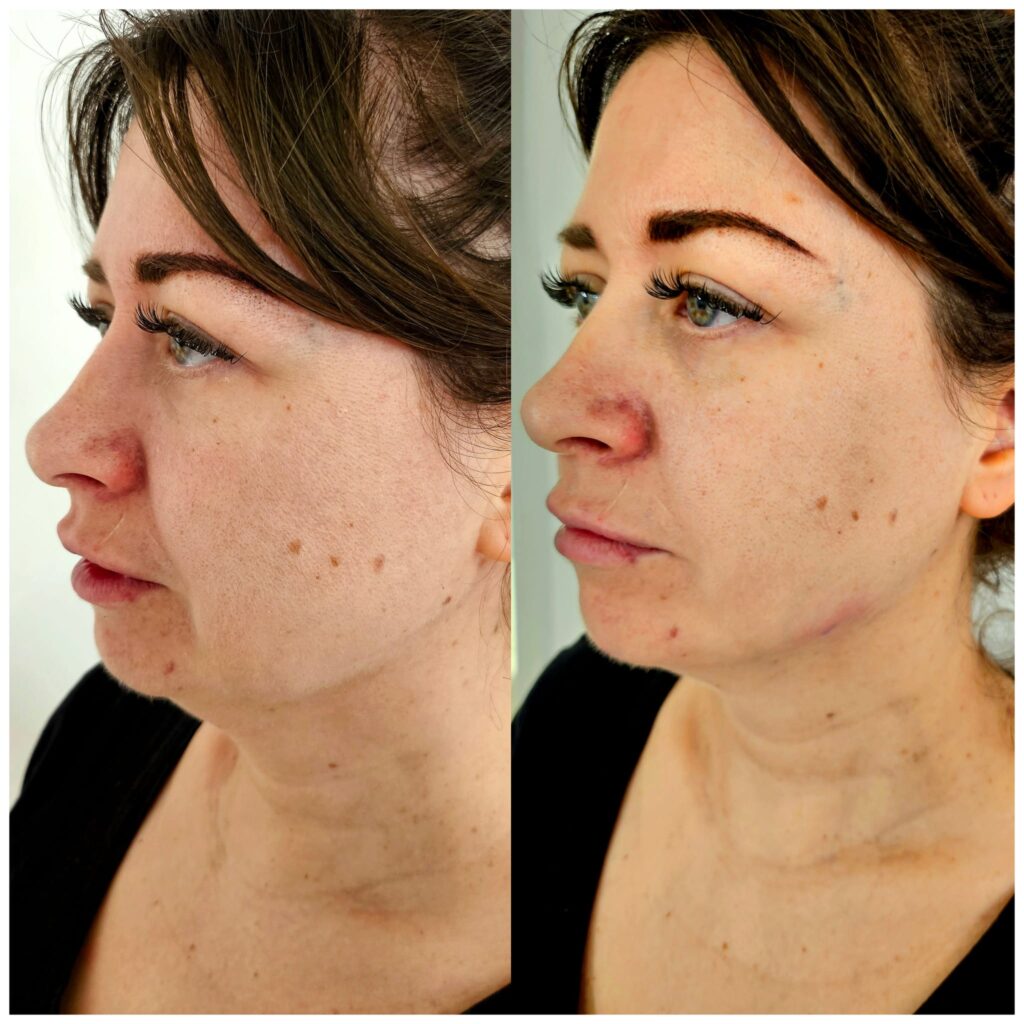 Before and after jawline filler treatment in Maidstone.