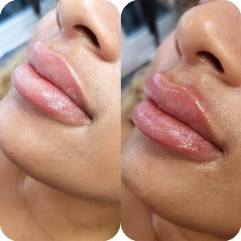 Cupid’s bow lip filler treatment result at our Maidstone lip filler clinic.