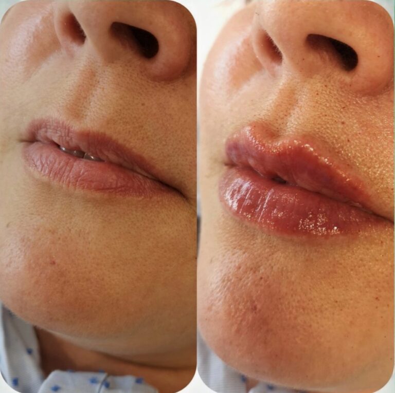 Before and after Juvederm lip filler treatment in Maidstone.