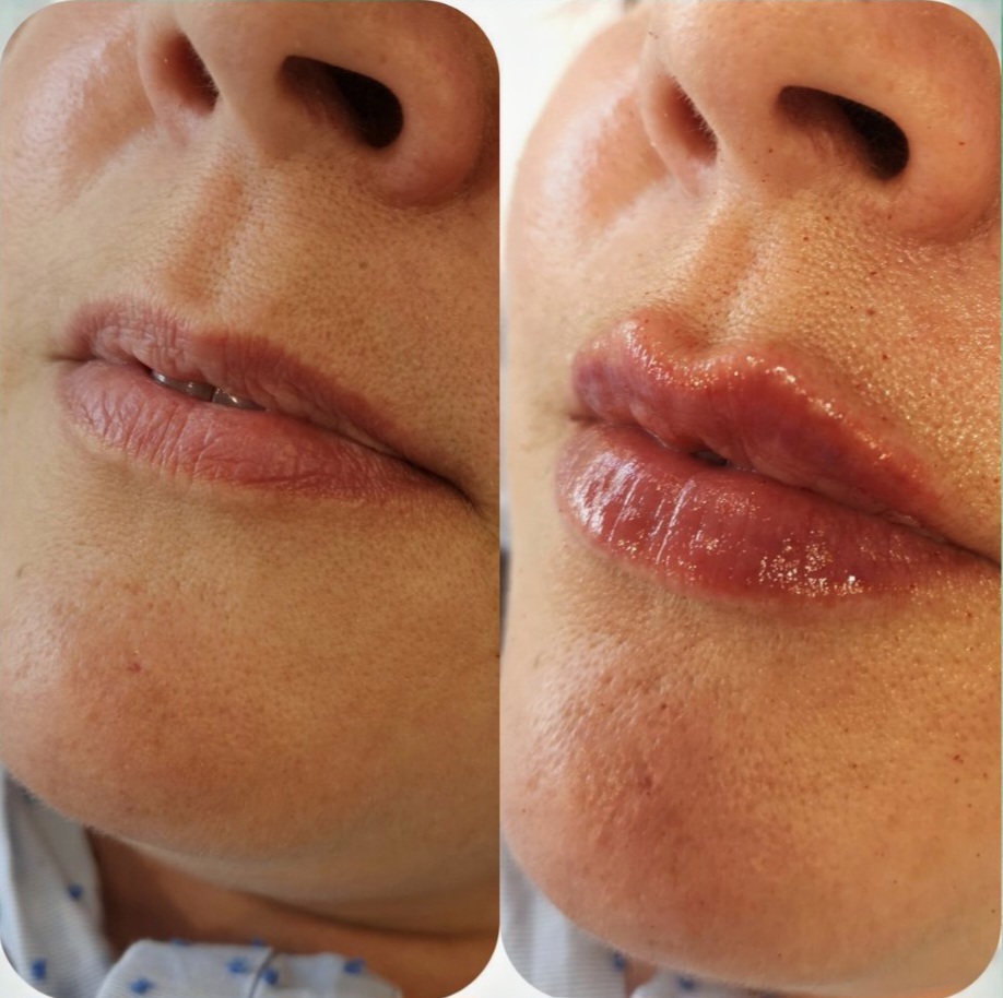 Before and after Juvederm lip filler treatment in Maidstone.