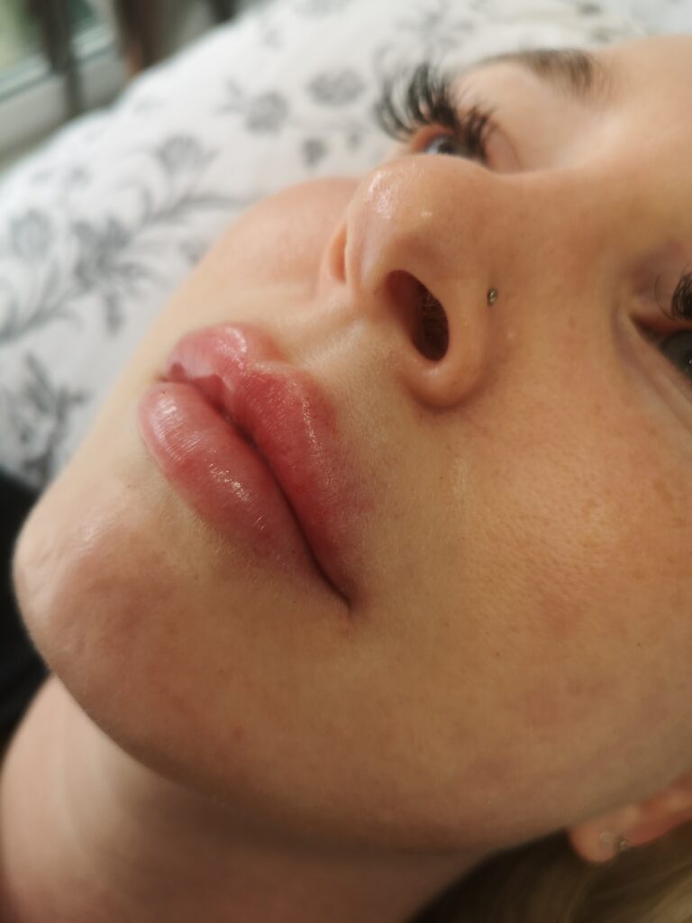 Woman after lip filler refill treatment showing balanced, natural-looking lips following dissolving and correction