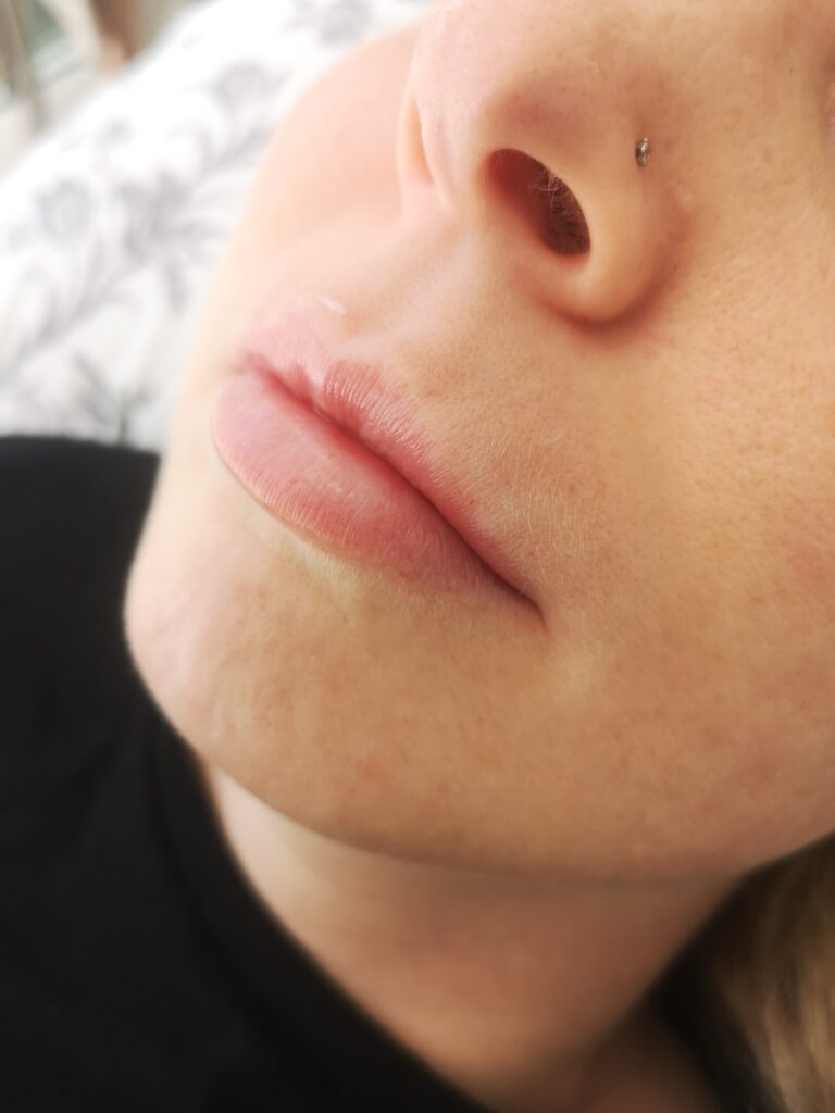 Woman after lip filler dissolving treatment showing natural lips with filler fully dissolved