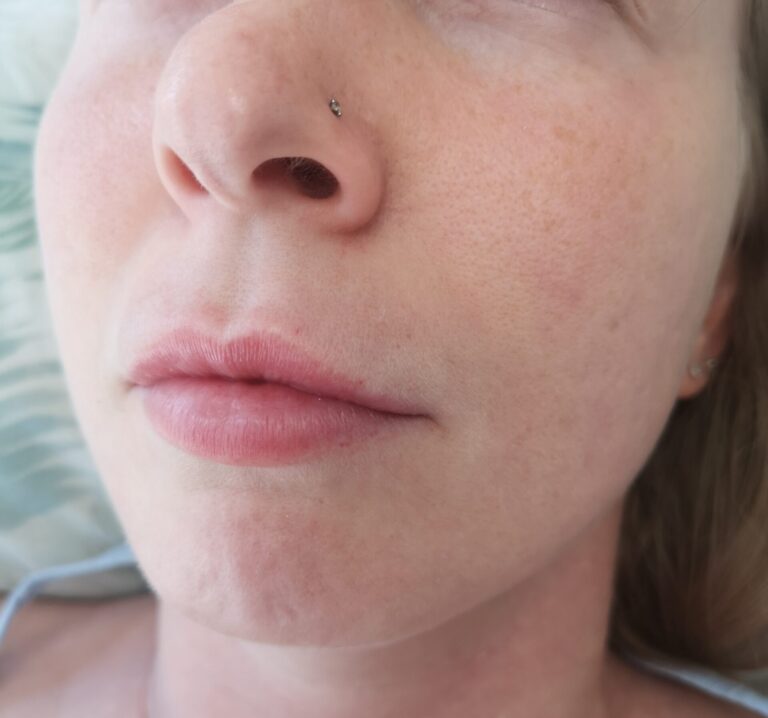 Woman before lip filler dissolving treatment showing lips with migrated filler above the lip line