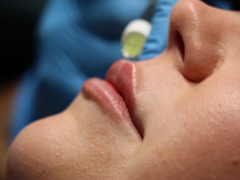 Close-up of lip filler treatment being performed by a medical aesthetics practitioner