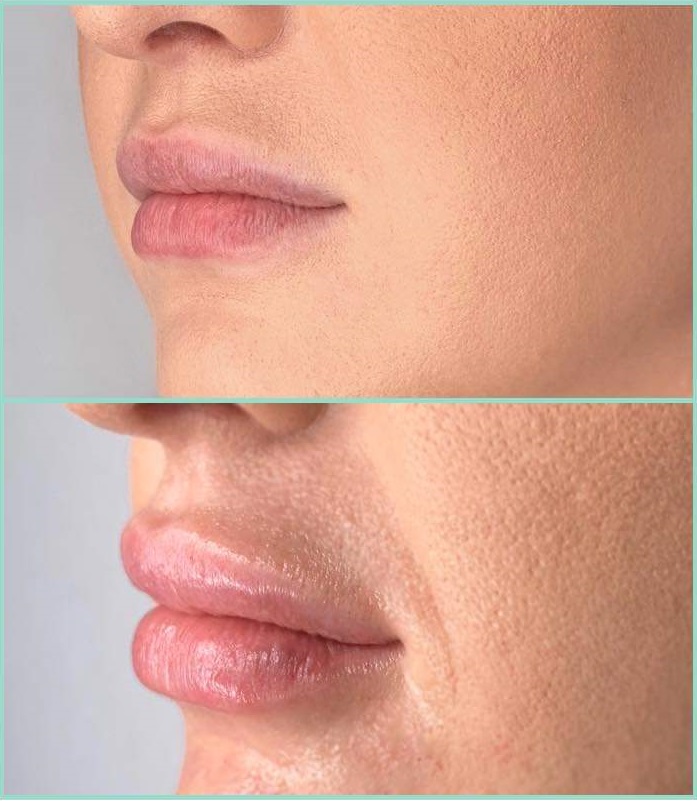 Before and after Juvederm lip filler result by a nurse-led clinic in Maidstone.