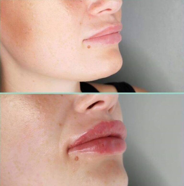 Before and after Revolax lip filler treatment at Awlin Beauty Maidstone.