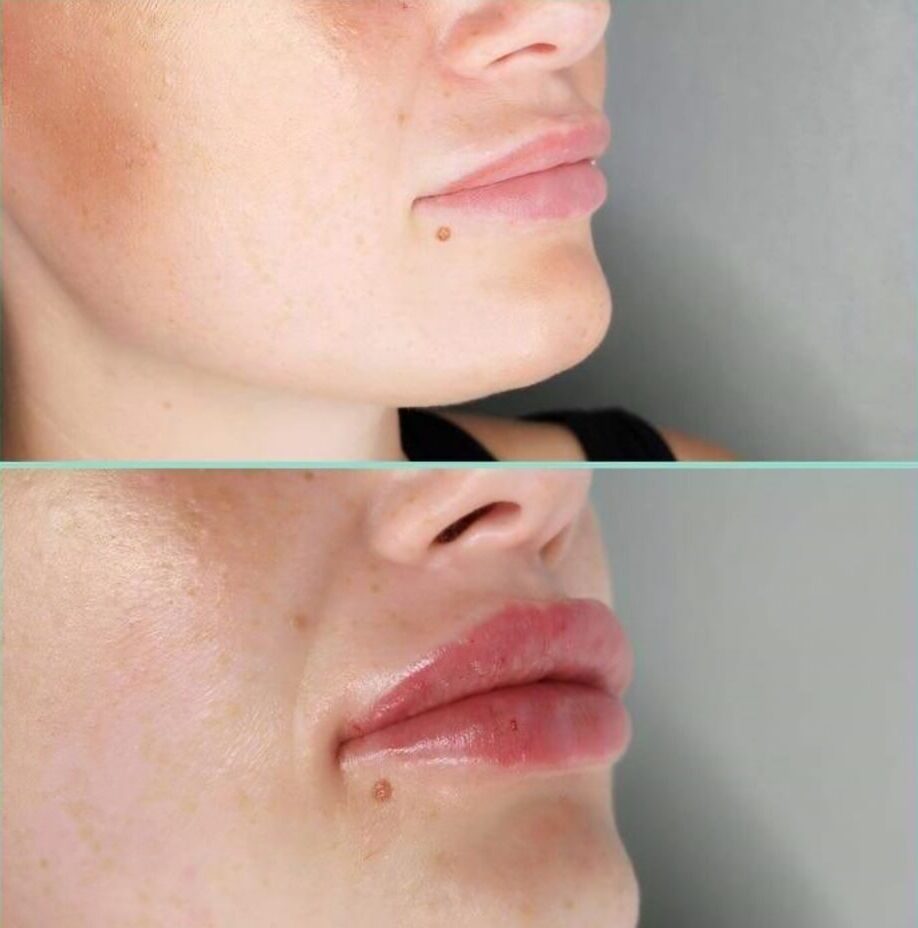 Before and after Revolax lip filler treatment at Awlin Beauty Maidstone.