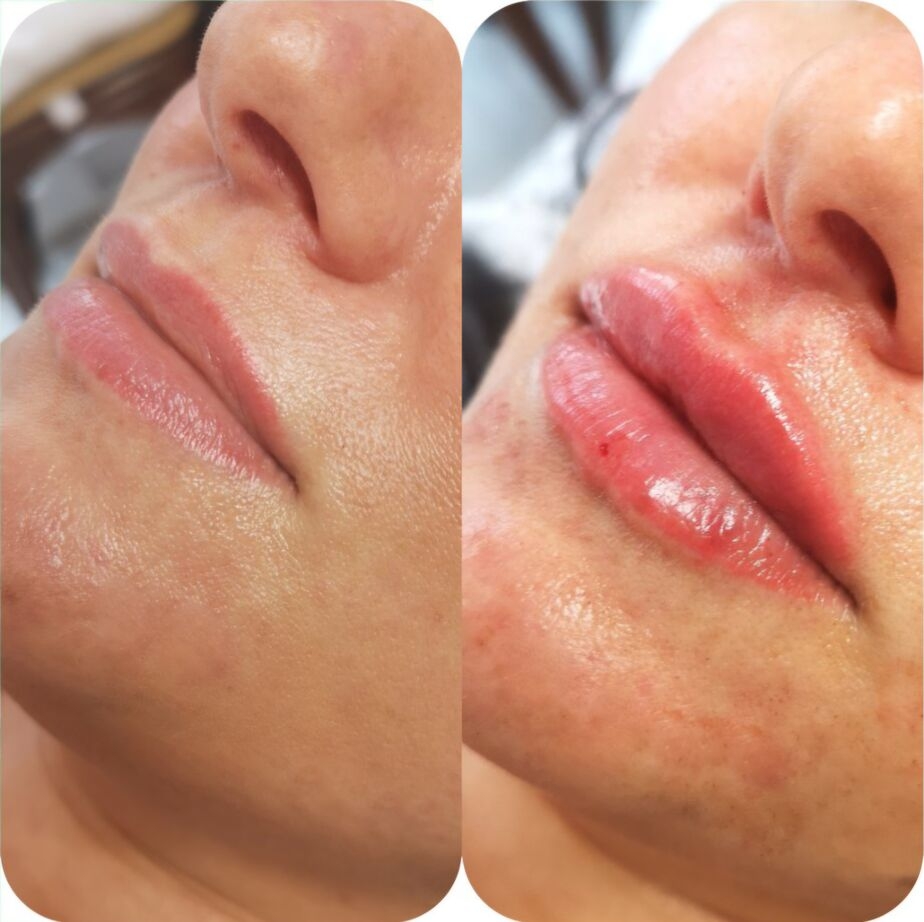 Before and after lip filler treatment result at our Maidstone clinic.