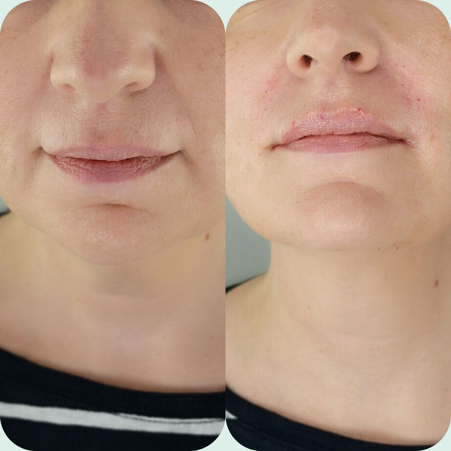 Before and after marionette lines and nasolabial folds treatment in Maidstone.