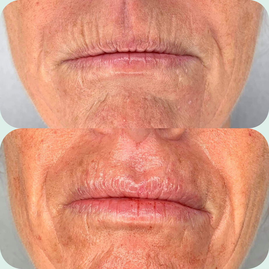 Before and after perioral lines filler treatment at our Maidstone aesthetics clinic.