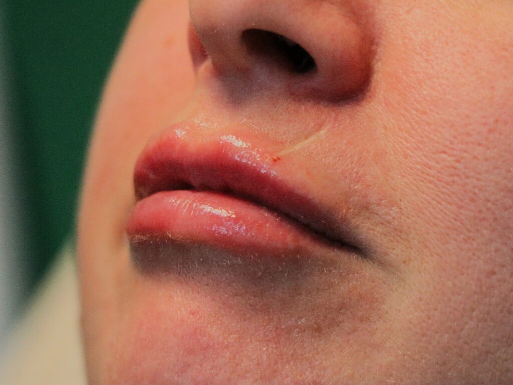 Lip filler swelling stages day by day guide for natural lip filler healing