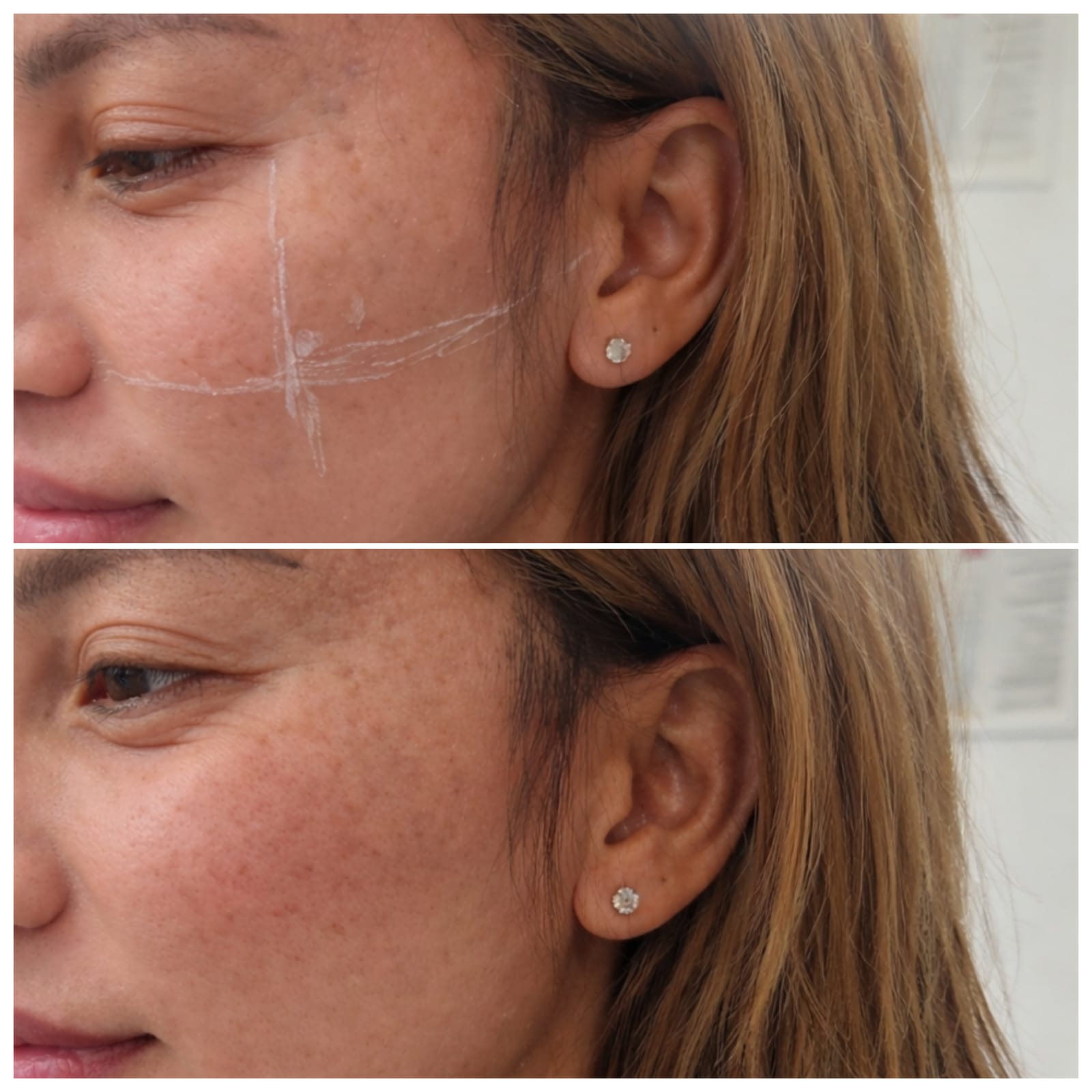 Before and after cheek filler treatment showing improved cheek contour and facial definition