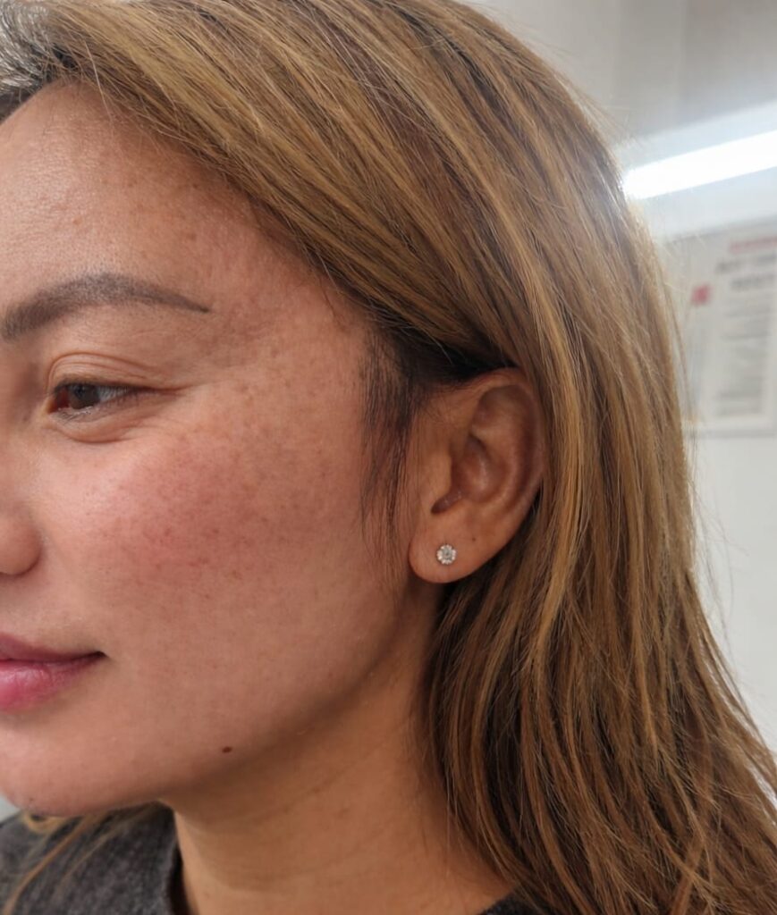 After jawline and cheek filler treatment showing improved jawline definition and smoother side profile contour