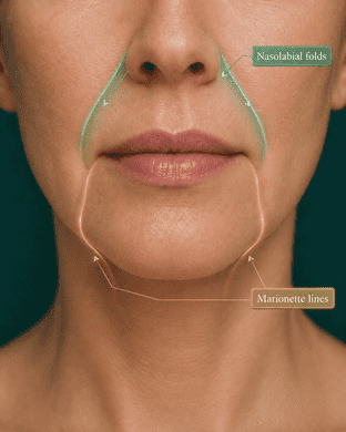 Diagram comparing nasolabial folds from the nose to mouth with marionette lines from the mouth to chin.