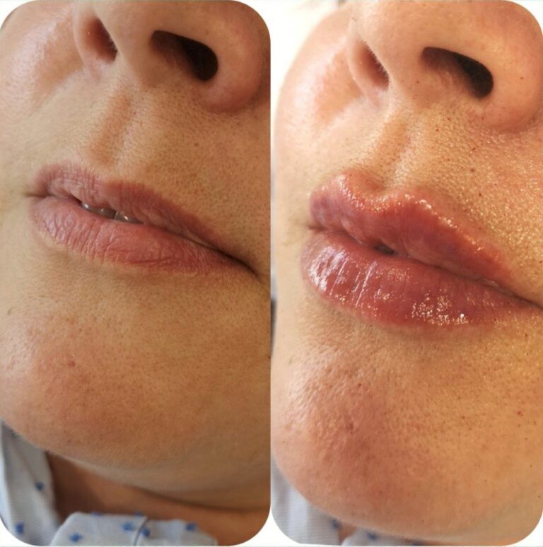 Natural lip filler before and after result in Maidstone showing soft, balanced enhancement