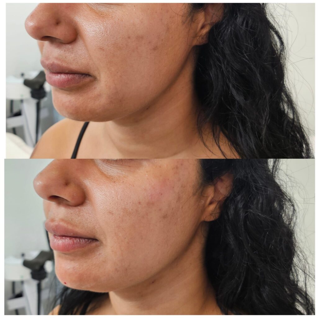 Cheek and chin filler before and after at Awlin Beauty Maidstone, 1ml cheek and 0.5ml chin filler for subtle profile balancing