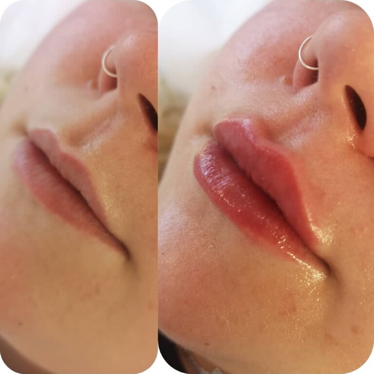 Before and after lip filler showing fuller lips and improved definition in Maidstone