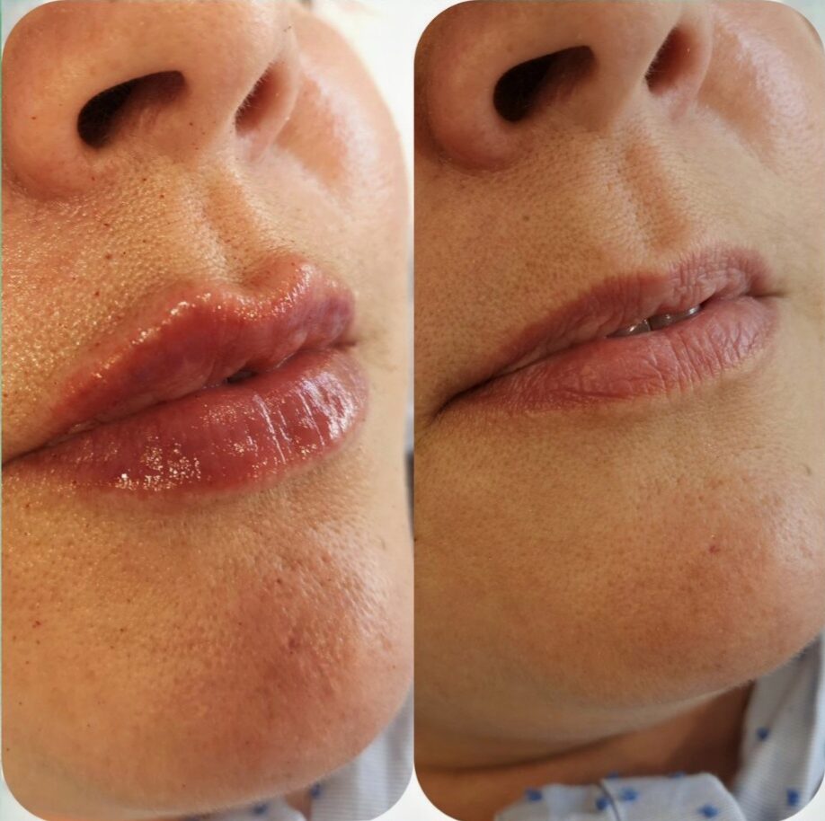 Cupid's bow lip filler before and after using Juvederm lip filler treatment at Awlin Beauty Maidstone