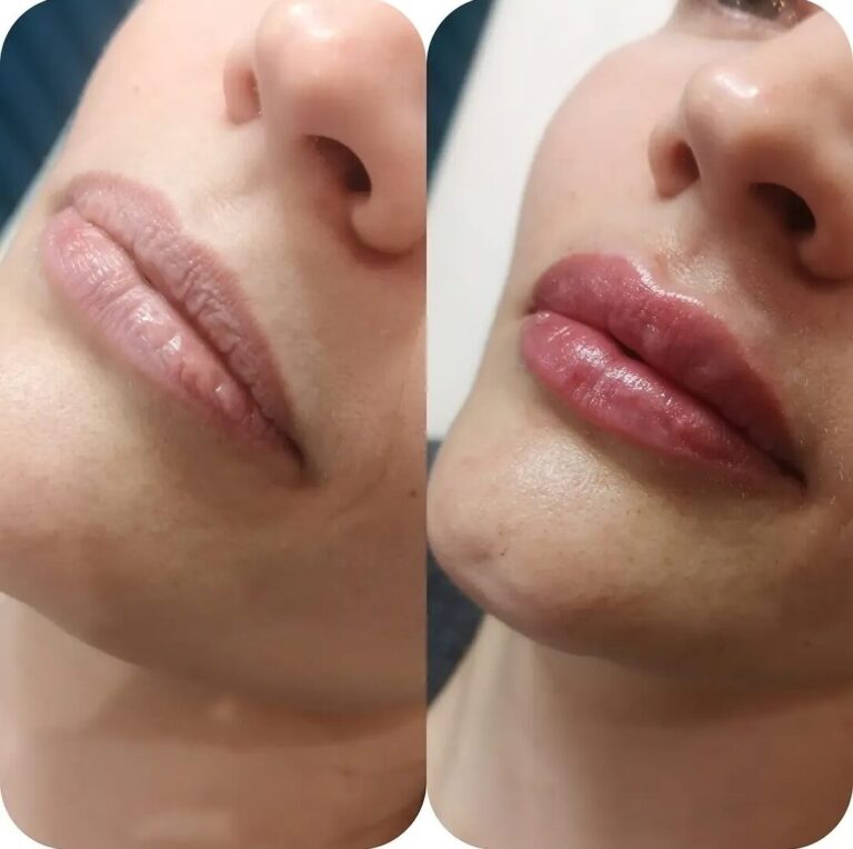 Lip filler before and after profile view showing improved projection and shape