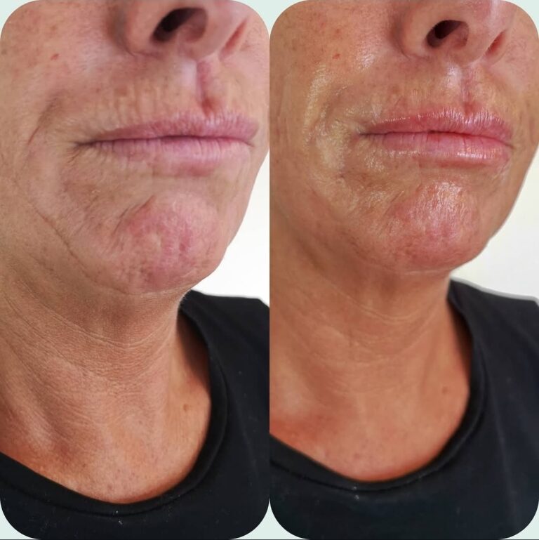 Natural marionette line filler result at a nurse-led clinic in Maidstone