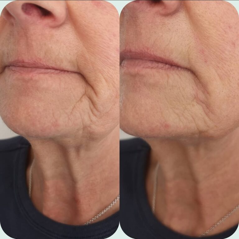 Before and after marionette lines treatment showing softening around the mouth corners and lower face