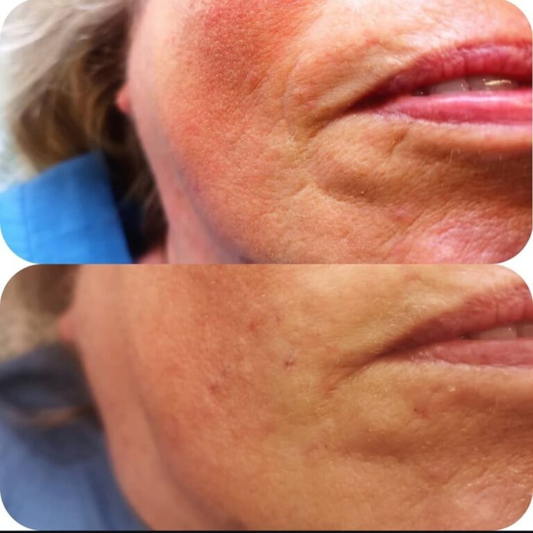 Close-up before and after marionette lines filler result around the mouth corner