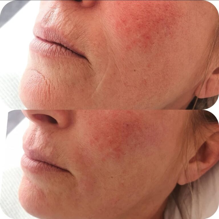 Before and after lower-face treatment showing reduced marionette lines and softer mouth-to-chin folds