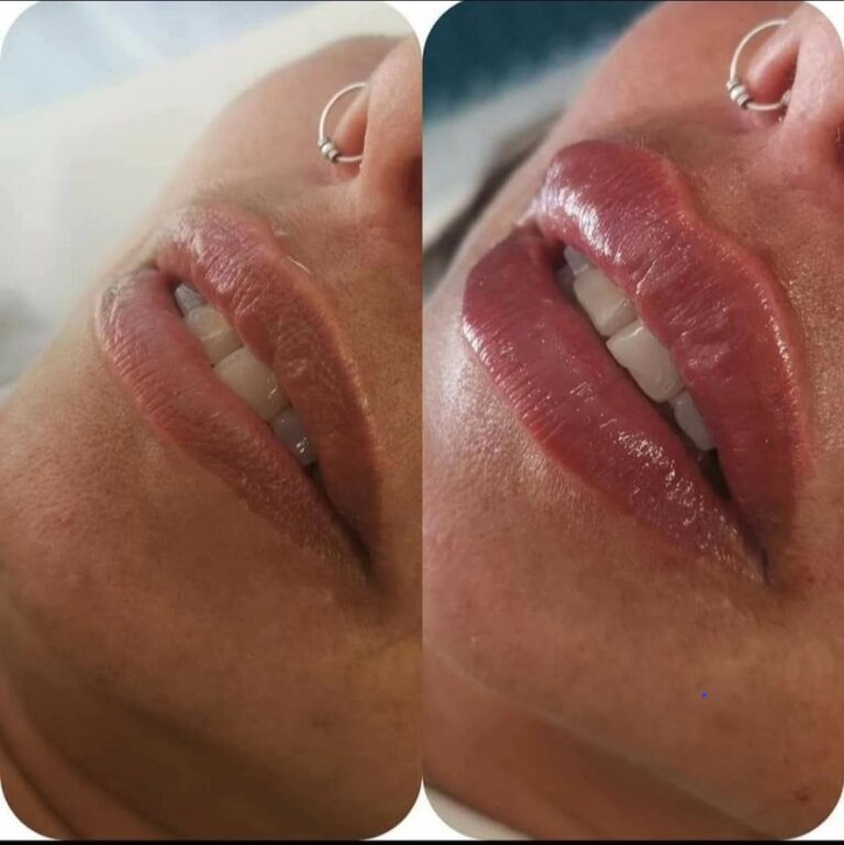 1ml lip filler before and after showing natural-looking lip volume and definition at Awlin Beauty Medical Aesthetics in Maidstone