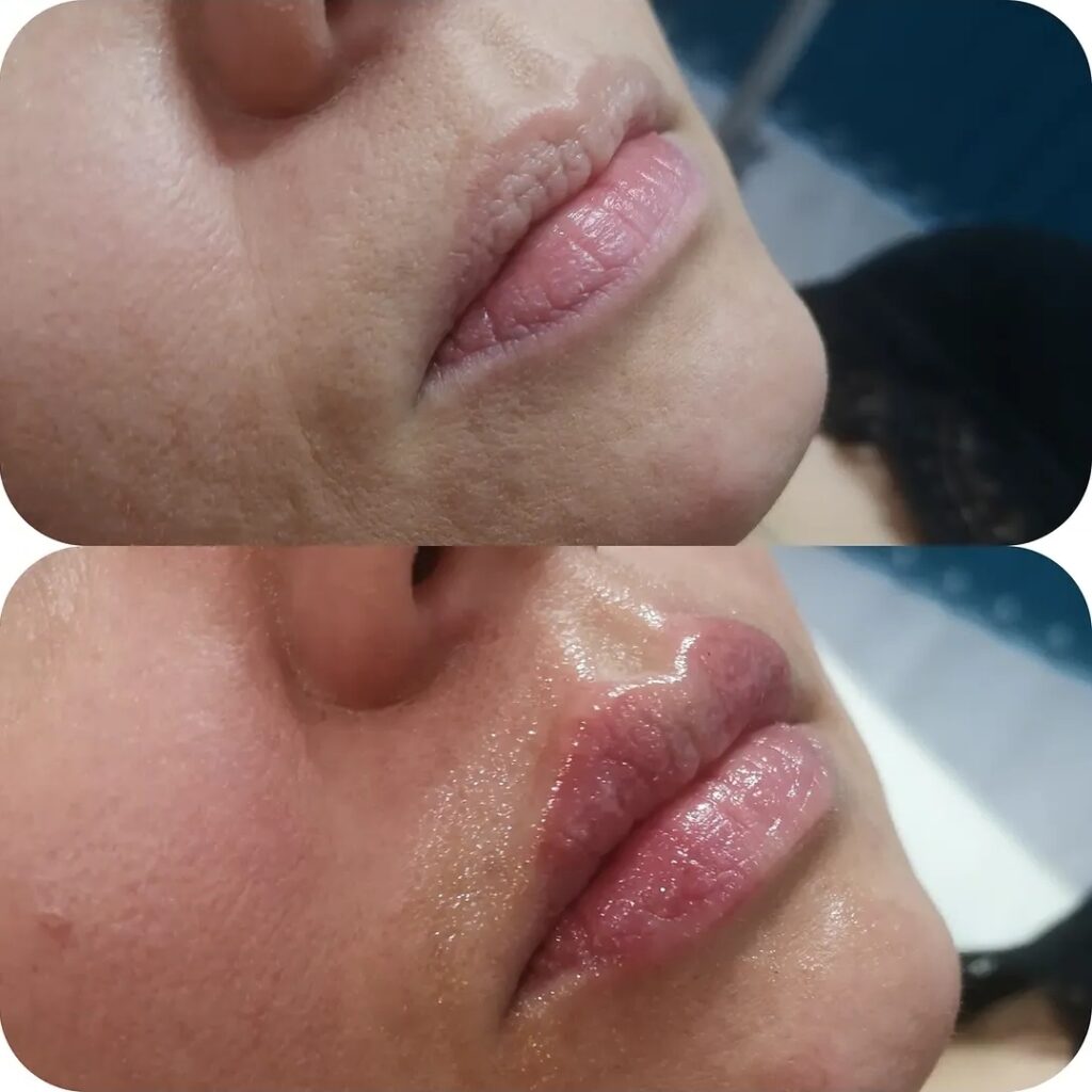 Natural lip filler before and after result showing fuller lips and improved shape at a Maidstone aesthetics clinic