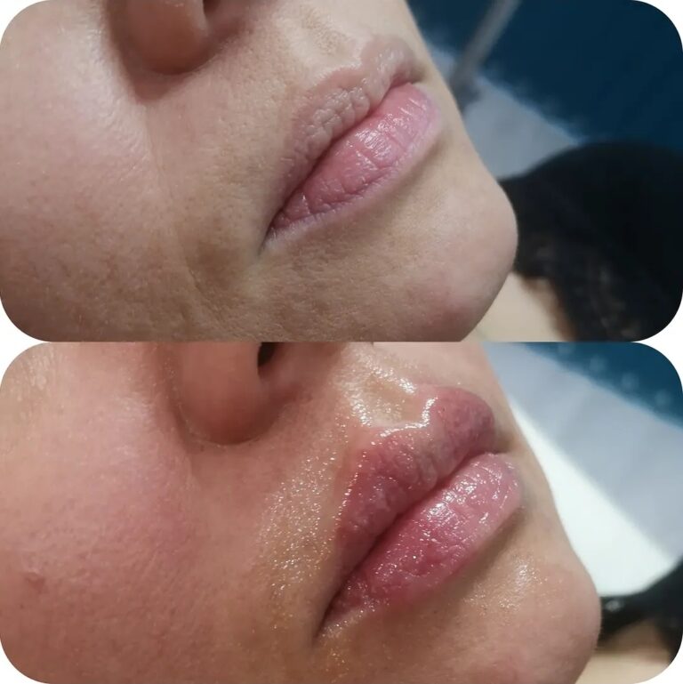 Natural lip filler before and after result showing fuller lips and improved shape at a Maidstone aesthetics clinic