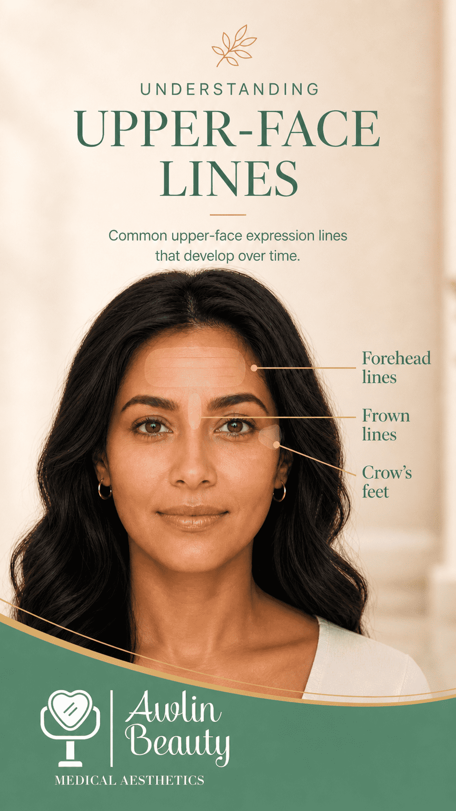 Diagram showing forehead lines, frown lines and crow’s feet around the upper face