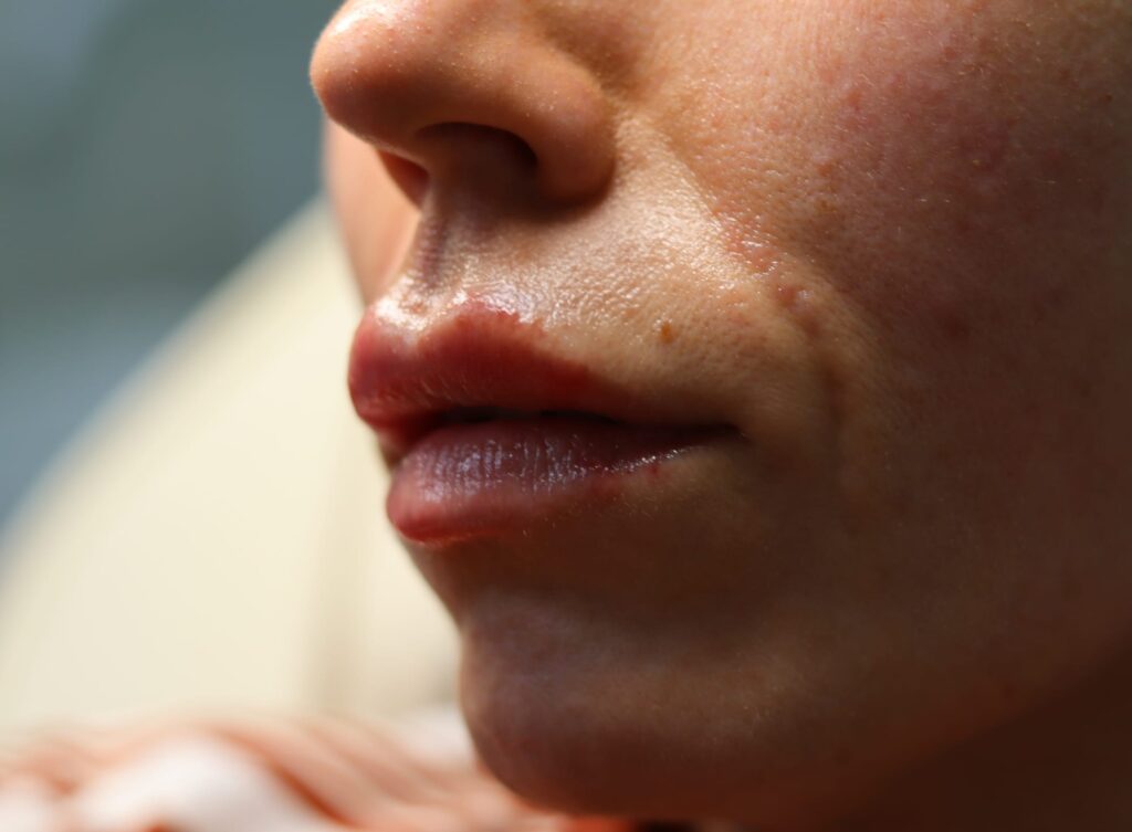 Natural lip filler result showing balanced defined lips at Awlin Beauty Maidstone