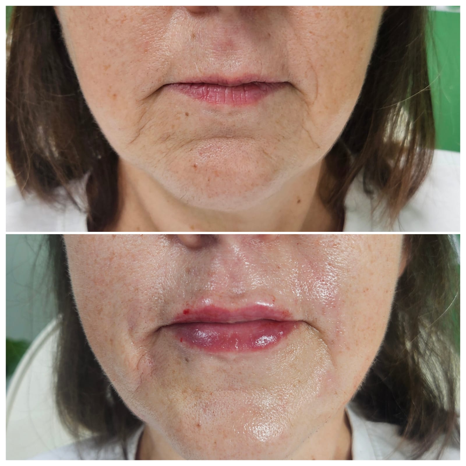 Before and after lip and nasolabial filler treatment at a Maidstone clinic