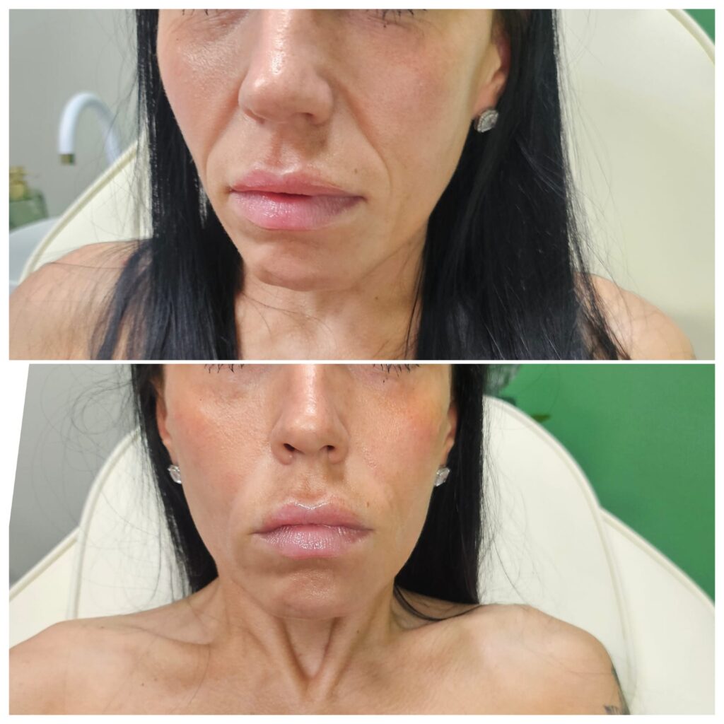Before and after skin booster treatment showing smoother, more refreshed skin, at a Maidstone clinic