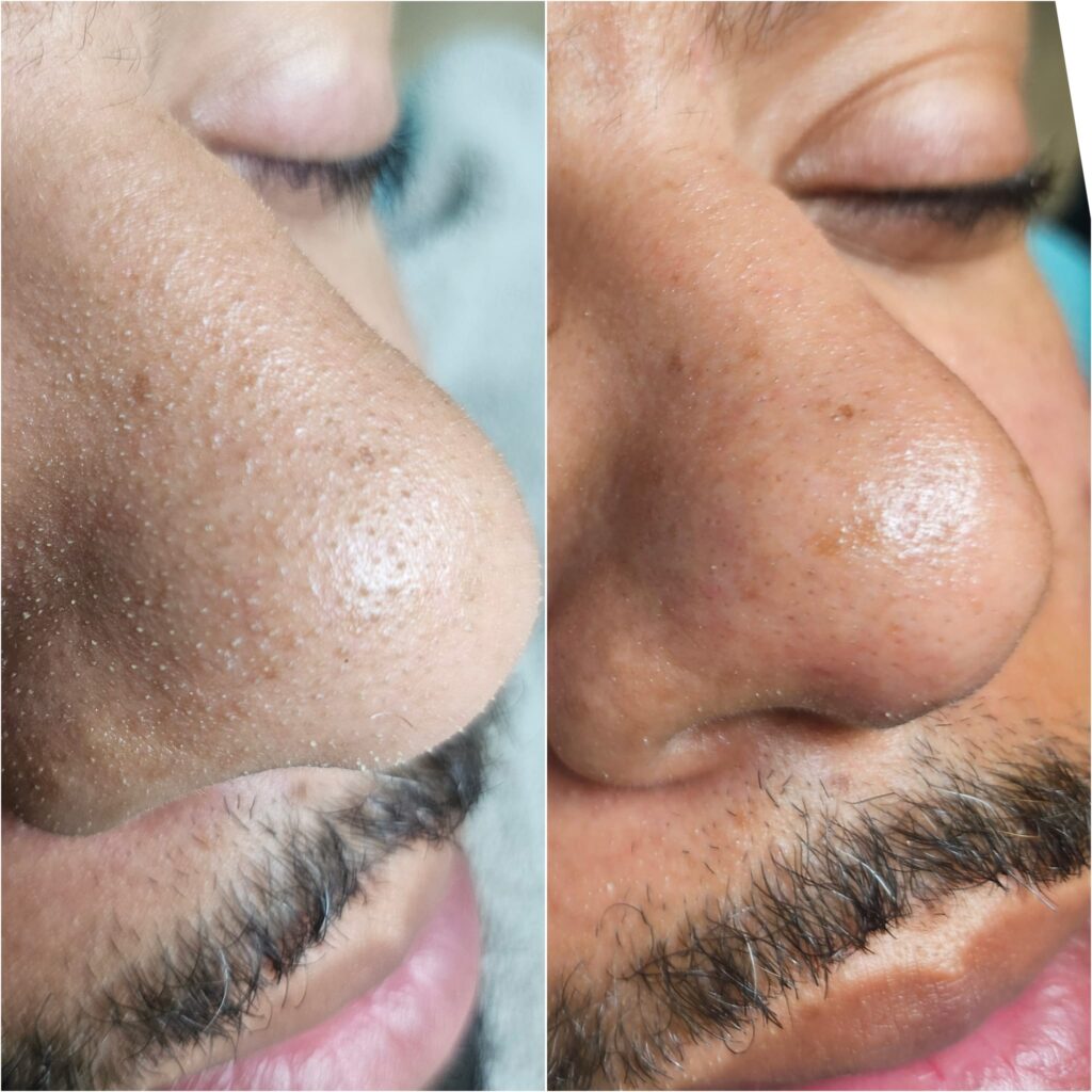 Before and after a facial at Awlin Beauty in Maidstone showing reduced blackheads and congestion on the nose