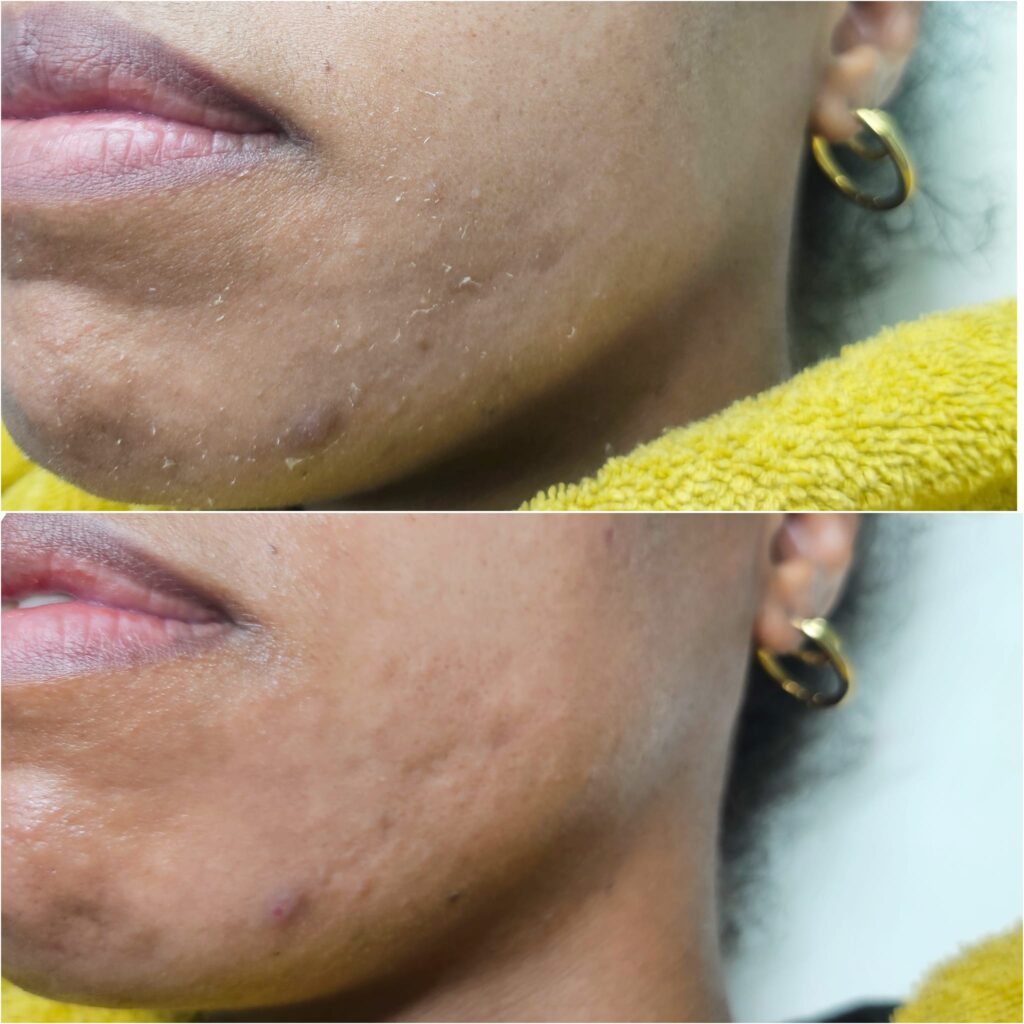 Before and after a facial at Awlin Beauty in Maidstone showing smoother, less flaky skin along the lower cheek and jaw