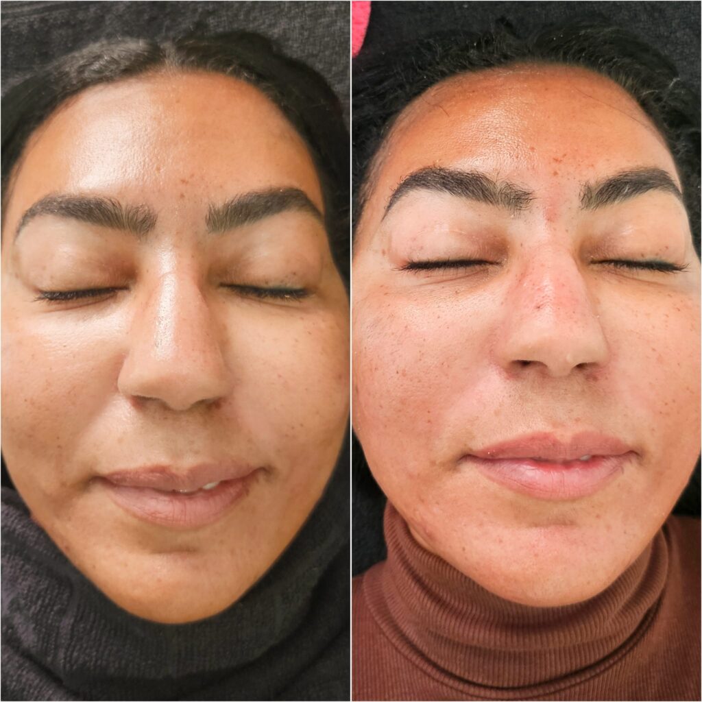Before and after a facial at Awlin Beauty in Maidstone showing smoother, brighter and more even skin