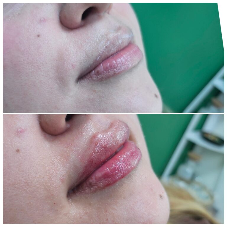 Lip filler before and after profile view showing added volume and shape, Maidstone