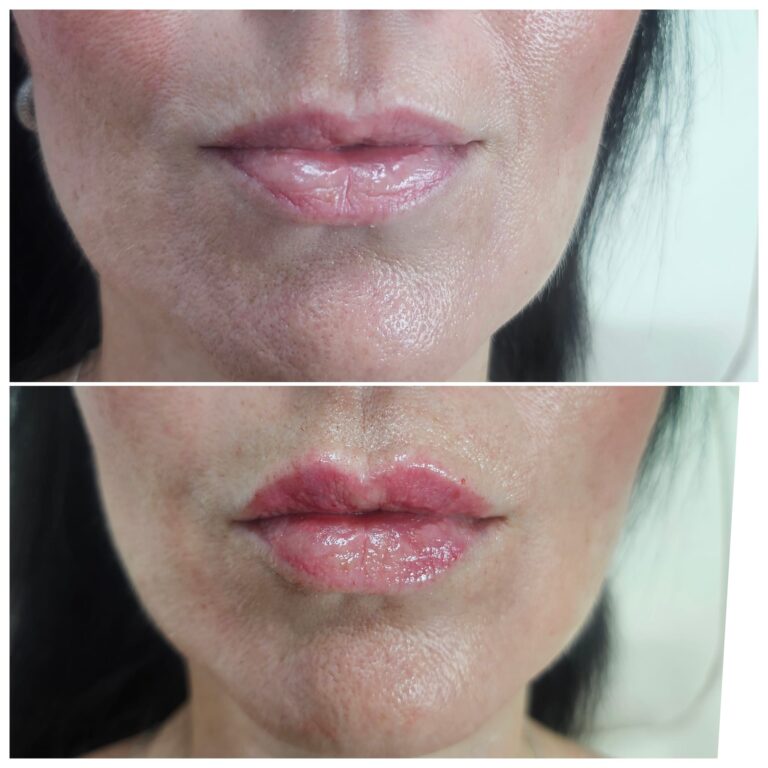 Lip filler before and after showing subtle natural definition and added volume, Maidstone