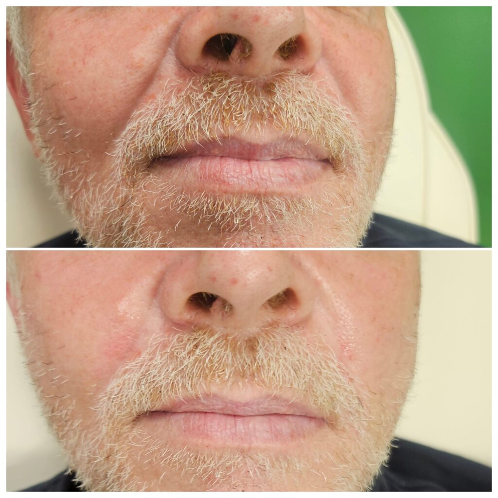 Before and after photo of nasolabial fold dermal filler treatment at Awlin Beauty, Maidstone