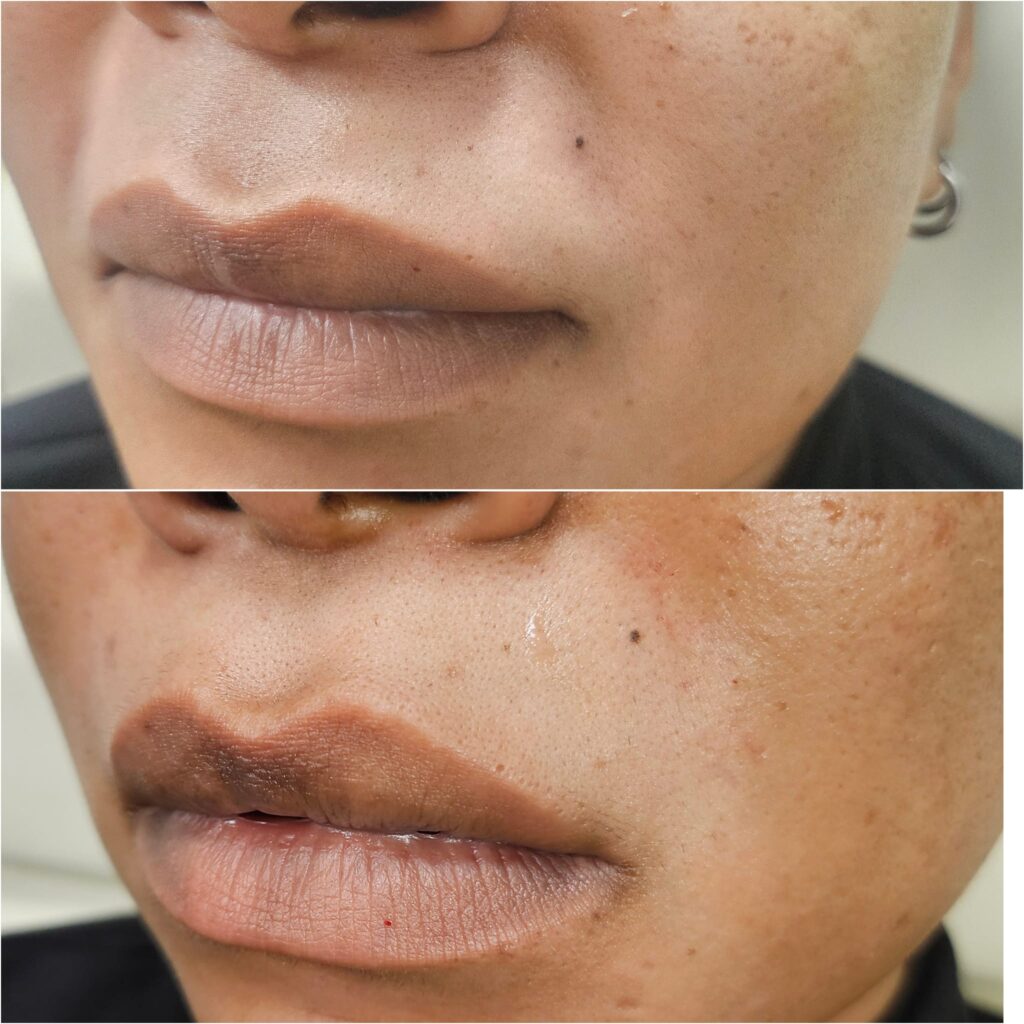 Before and after nasolabial lines dermal filler treatment, performed by a registered nurse at Awlin Beauty in Maidstone