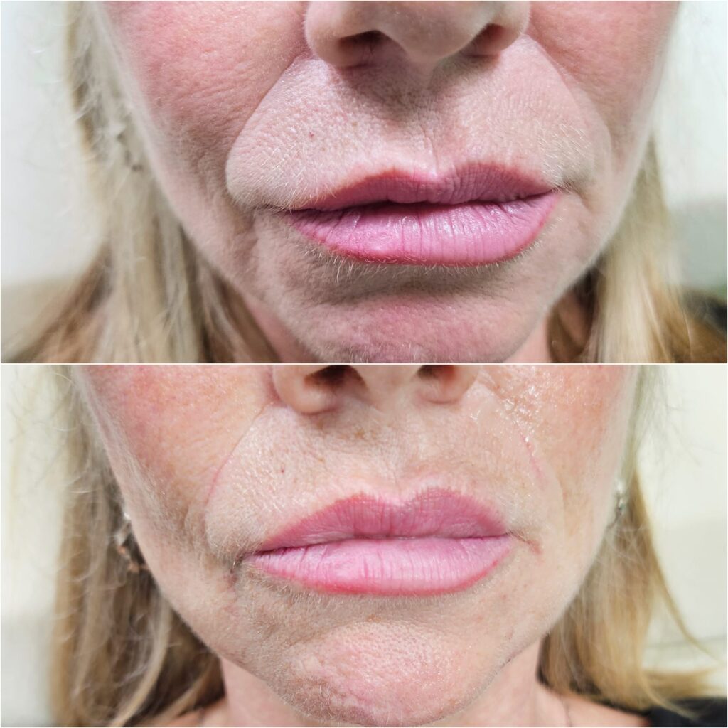 Before and after nasolabial lines dermal filler treatment around the nose and mouth, performed by a registered nurse at Awlin Beauty in Maidstone